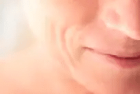 Restylane® Marionette Lines Treatment